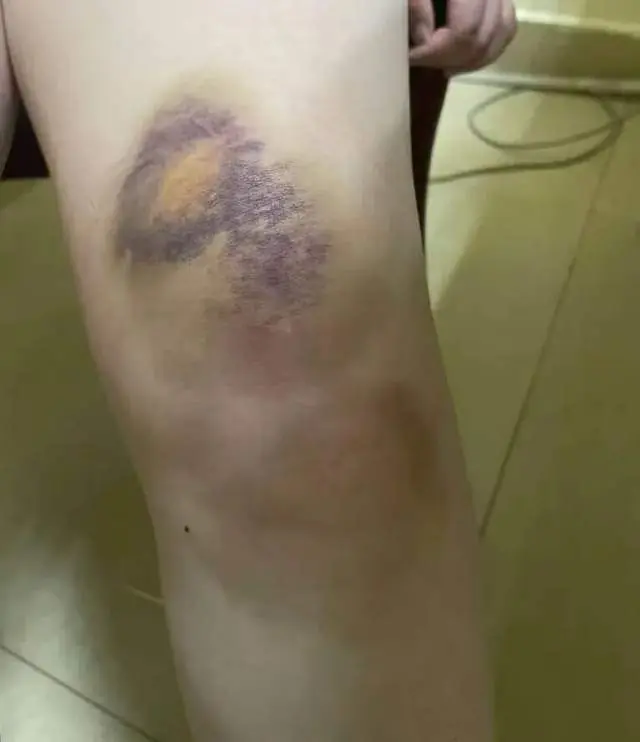 王敏的左膝位置有严重的淤青。图片来源/受访者